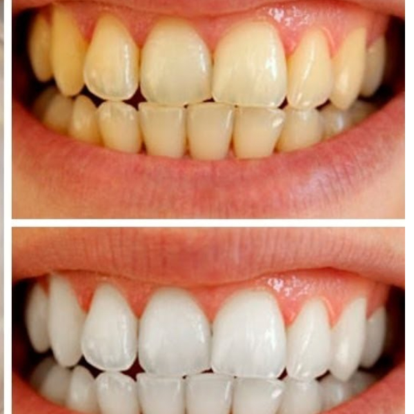 لایه برداری و سفید کردن دندان ها